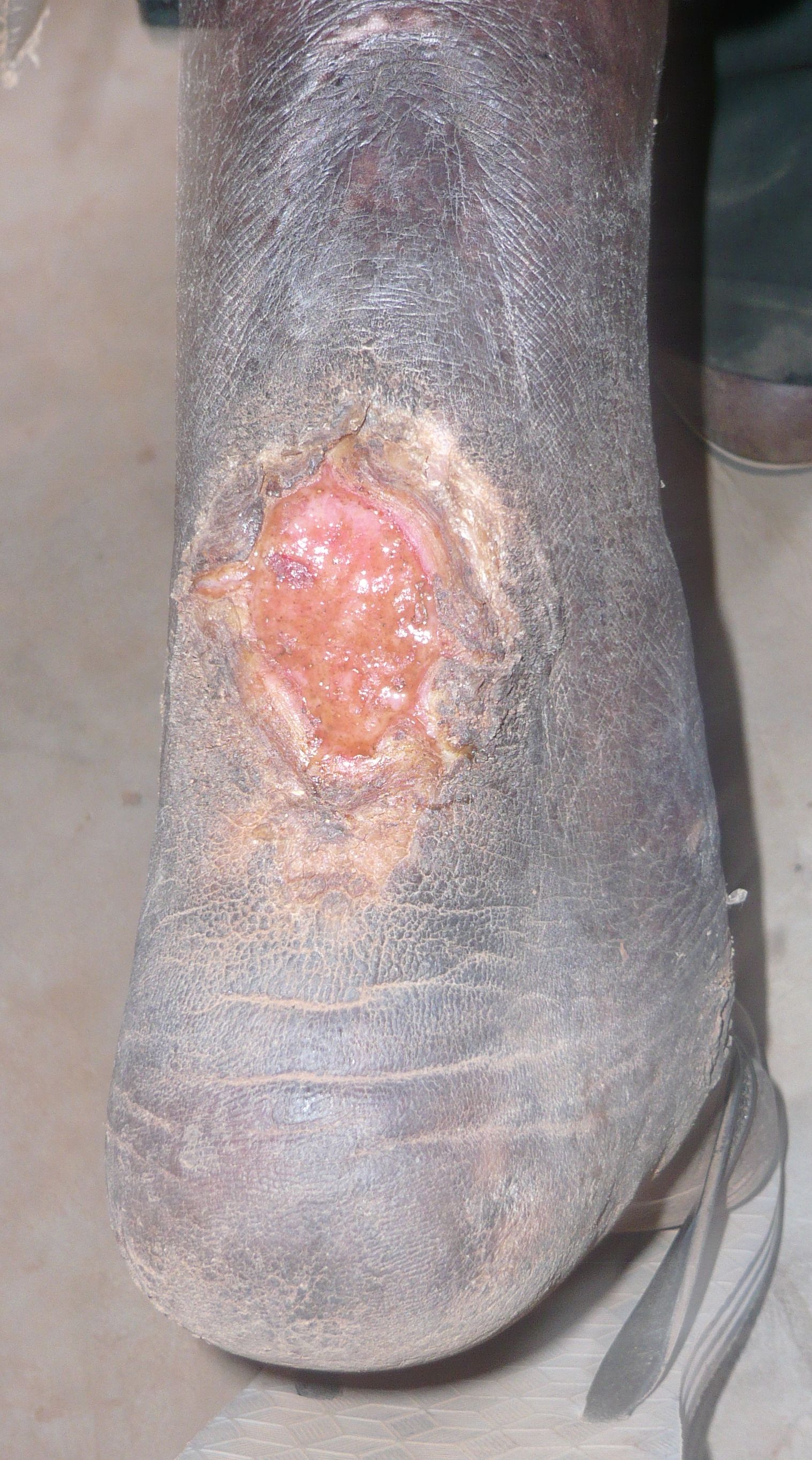 Leprosy Leg Wound